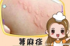 風疹塊止癢小妙招，蕁麻疹最怕四個土方