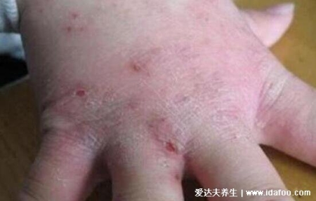 皮膚病圖片對照大全查看圖片，包含100種疾病的癥狀圖自測