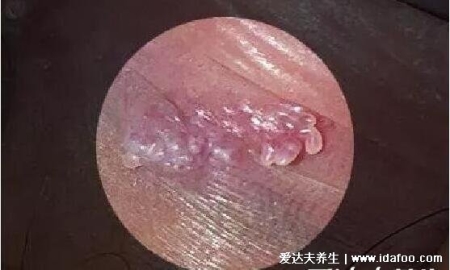 尖銳濕尤圖癥狀圖片男性癥狀，隱私部位現菜花狀疣體(潛伏期多在3個月)