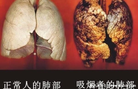 長期抽電子煙體檢報告出來了，出現多個良性肺部結節(警惕癌變)