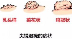 尖銳濕尤圖癥狀圖片男性癥狀，隱私部位
