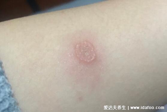 圓癬體癬錢幣癬初期圖片和癥狀，圓形紅斑邊緣有一圈脫屑瘙癢