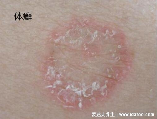 圓癬體癬錢幣癬初期圖片和癥狀，圓形紅斑邊緣有一圈脫屑瘙癢