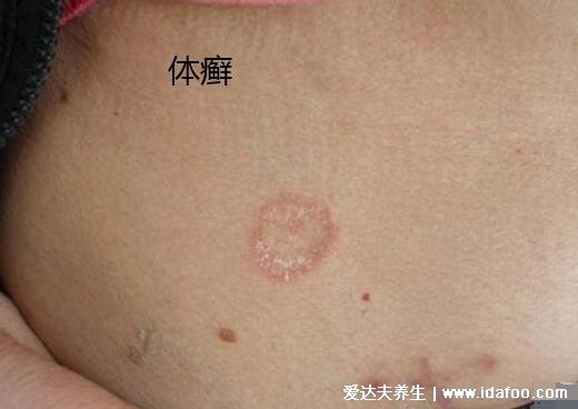 圓癬體癬錢幣癬初期圖片和癥狀，圓形紅斑邊緣有一圈脫屑瘙癢