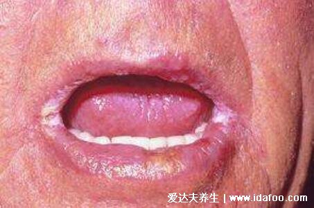 初期口角炎圖片及癥狀，嘴角起皰會糜爛結痂(3種類型附醫治法)