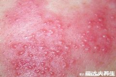 100種皮膚病對照表，警惕常見皮膚病類型