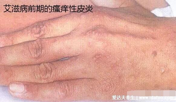一個月不發燒基本排除艾滋病，不準確潛伏期可達15年(信任檢測結果)