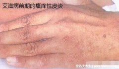 艾滋病有潛伏期嗎能檢測么(艾滋病無癥狀