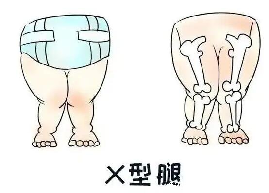 嬰兒佝僂病睡姿圖片，警惕骨骼發育的4種情況(平躺睡覺) 
