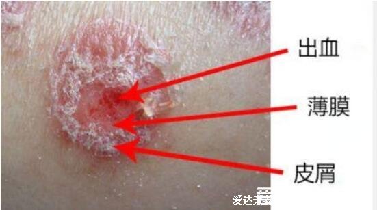 頭皮上有白色大片的皮是怎么回事圖片，頭皮糠疹可造成脫發