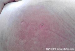全身浮腫褥瘡潰爛成洞能活多久(褥瘡嚴重