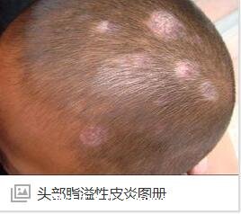 頭皮上有白色大片的皮是怎么回事圖片，頭皮糠疹可造成脫發