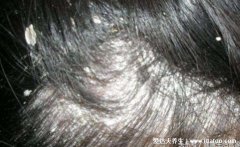 頭皮糠疹引起掉發多的治療方法(頭皮糠疹