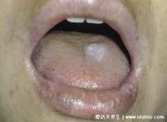 扁平苔蘚癬長到嘴唇上(口腔丘疹扁平苔蘚
