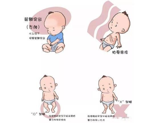 嬰兒佝僂病睡姿圖片，警惕骨骼發育的4種情況(平躺睡覺) 