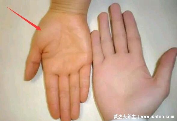 真實的肝掌圖片高清圖片，肝掌/蜘蛛痣可能是嚴重肝病的前兆