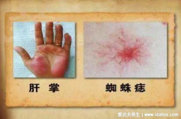 真實的肝掌圖片高清圖片，肝掌/蜘蛛痣可能是嚴重肝病的前兆