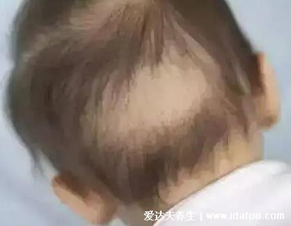 嬰兒佝僂病睡姿圖片，警惕骨骼發育的4種情況(平躺睡覺) 
