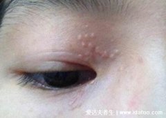 上顎有一個凸起的小疙瘩不痛不癢(皮膚下
