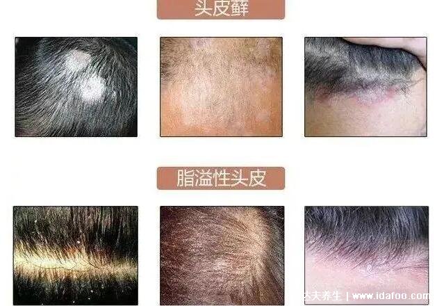 頭皮上有白色大片的皮是怎么回事圖片，頭皮糠疹可造成脫發