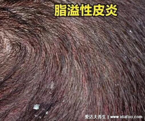 頭皮上有白色大片的皮是怎么回事圖片，頭皮糠疹可造成脫發