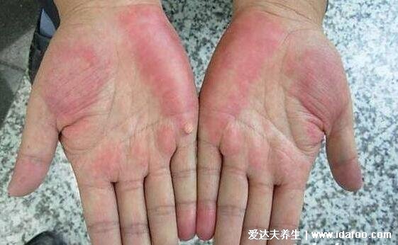 真實的肝掌圖片高清圖片，肝掌/蜘蛛痣可能是嚴重肝病的前兆