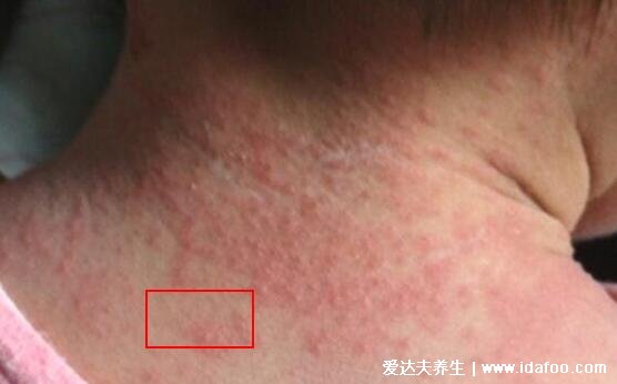 痱子和濕疹的區別圖片，外貌癥狀都不相同一眼可分辨