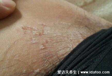 初期女性股癬圖片及癥狀，大腿肚內側長環狀紅斑有劇烈瘙癢