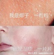 痱子和濕疹怎么區分(濕疹和痱子的區別