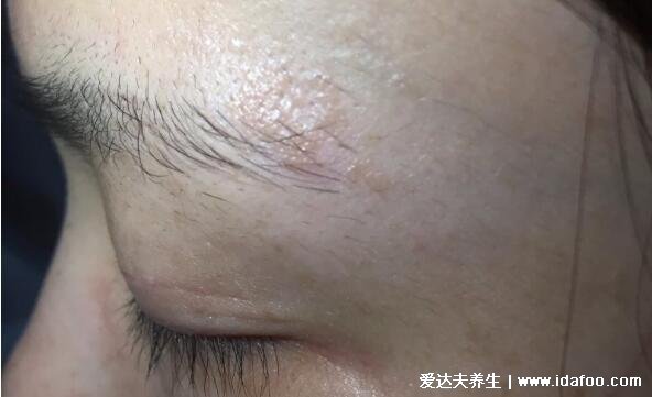 初期女性股癬圖片及癥狀，大腿肚內側長環狀紅斑有劇烈瘙癢