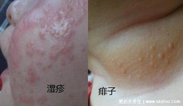 痱子和濕疹的區別圖片，外貌癥狀都不相同一眼可分辨