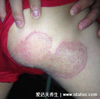 初期女性股癬圖片及癥狀，大腿肚內側長環狀紅斑有劇烈瘙癢