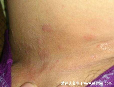 初期女性股癬圖片及癥狀，大腿肚內側長環狀紅斑有劇烈瘙癢