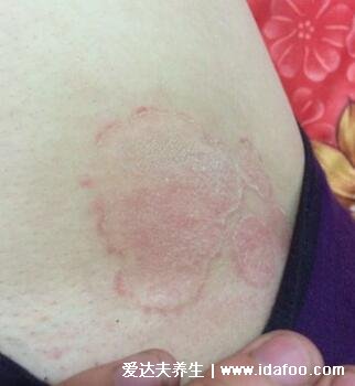 初期女性股癬圖片及癥狀，大腿肚內側長環狀紅斑有劇烈瘙癢