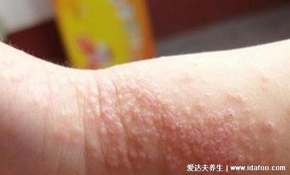 痱子和濕疹的區別圖片，外貌癥狀都不相同一眼可分辨