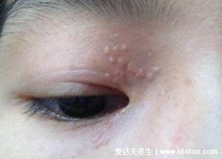 18種常見的皮膚病圖片對照表，濕疹/蕁麻疹/扁平疣/毛囊炎合集