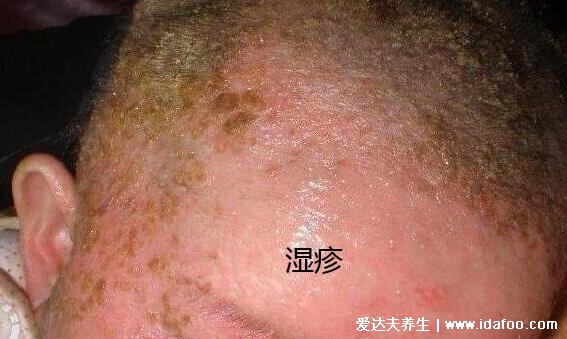 痱子和濕疹的區別圖片，外貌癥狀都不相同一眼可分辨