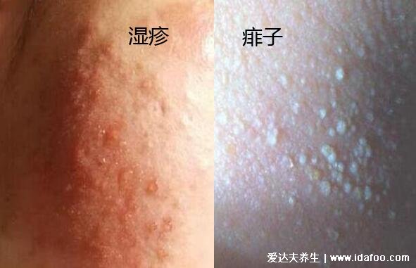 痱子和濕疹的區別圖片，外貌癥狀都不相同一眼可分辨