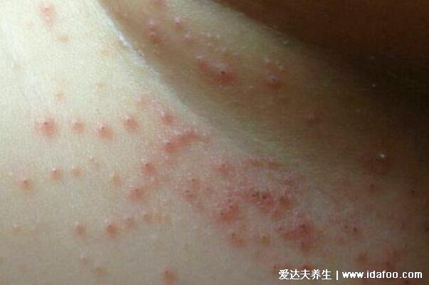痱子和濕疹的區別圖片，外貌癥狀都不相同一眼可分辨