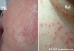 18種常見的癢皮膚病(常見的皮膚病疣)