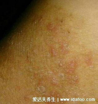 初期女性股癬圖片及癥狀，大腿肚內側長環狀紅斑有劇烈瘙癢