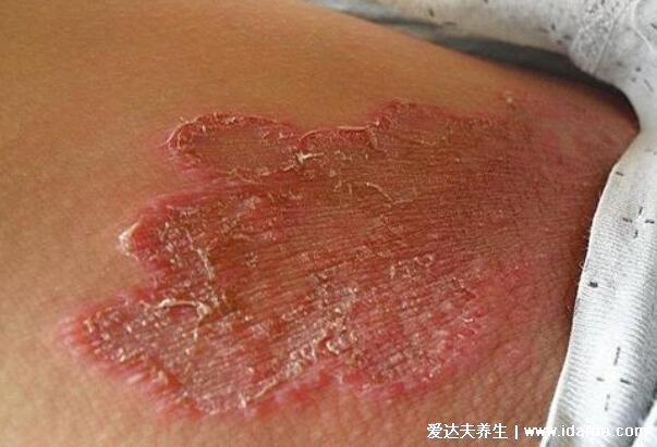 初期女性股癬圖片及癥狀，大腿肚內側長環狀紅斑有劇烈瘙癢