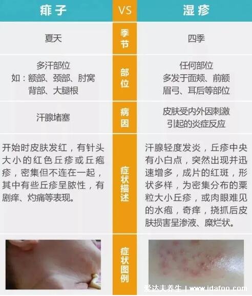 一張圖教你區別濕疹和痱子，從部位/癥狀/時間區分(濕疹時間長)