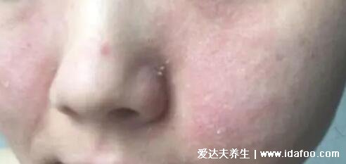 臉部過敏性皮炎圖片和癥狀，丘疹紅斑瘙癢避免抓癢(3種類型圖)