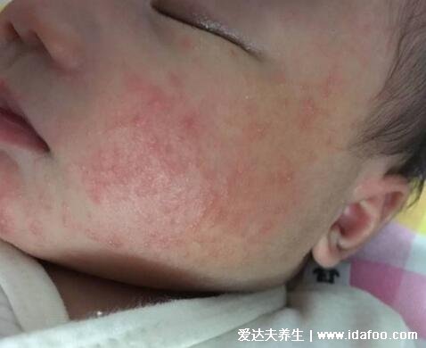 一張圖教你區別濕疹和痱子，從部位/癥狀/時間區分(濕疹時間長)