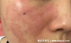 臉部過敏性皮炎圖片和癥狀，丘疹紅斑瘙