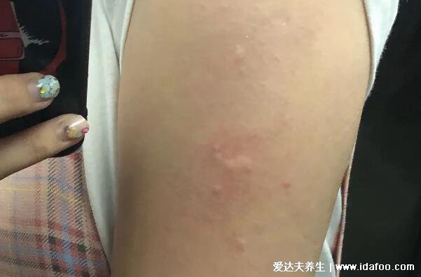 打完第三針新冠疫苗后的不良反應有哪些，輕微的胳膊紅腫發癢
