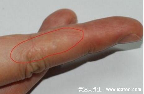 100種癬的種類與辨別圖片，體癬/手癬/頭癬/腳癬/股癬對照圖