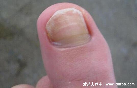 100種癬的種類與辨別圖片，體癬/手癬/頭癬/腳癬/股癬對照圖