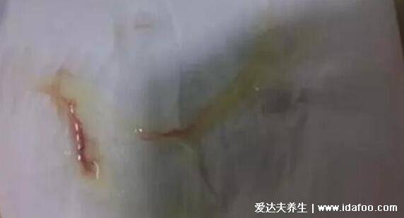 不要輕易做HPV和TCT檢查為謠言，及時發現病毒感染和宮頸病變
